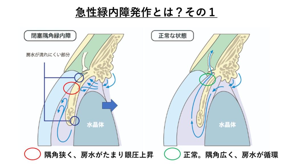 急性緑内障。狭隅角から起こる房水の停滞 出展元: 経堂こうづき眼科