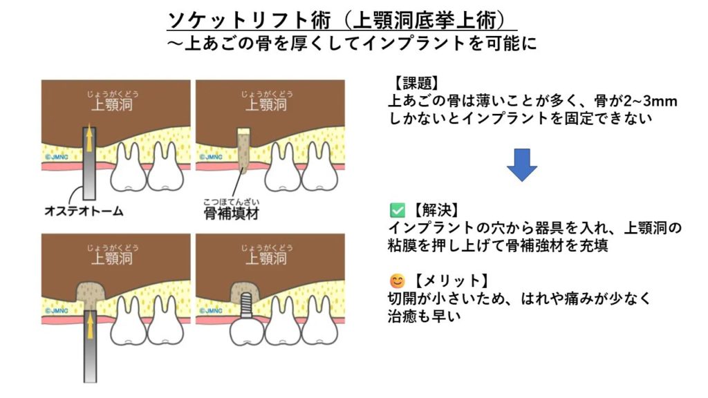 ソケットリフト術~上あごの骨を厚くしてインプラントを可能に
出典元:品川御殿山 クレイン歯科
