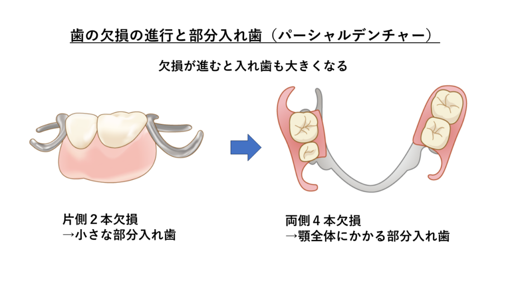 歯の欠損の進行と部分入れ歯
出典元:守谷歯科医院