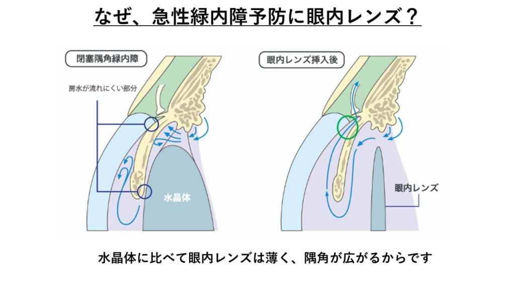 眼内レンズで隅角を広げ急性緑内障を予防。
出典元:経堂こうづき眼科