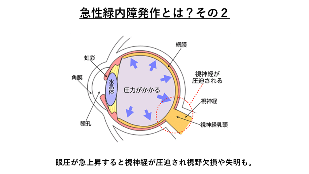 眼圧の上昇が視神経を圧迫。
出典元:経堂こうづき眼科