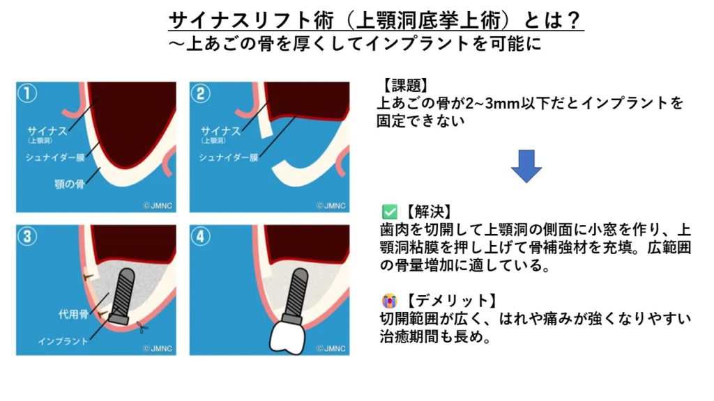 サイナスリフト術(上顎洞底挙上術)とは?
出典元:品川御殿山 クレイン歯科